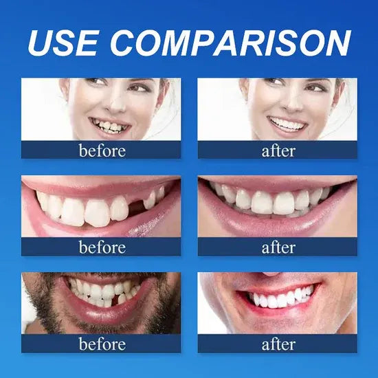 🔥Ends Today: 79% OFF!🏆2026 Bestselling Product🦷 Fit for a Fresh Smile, Say Goodbye to Wearing Discomfort!🌎