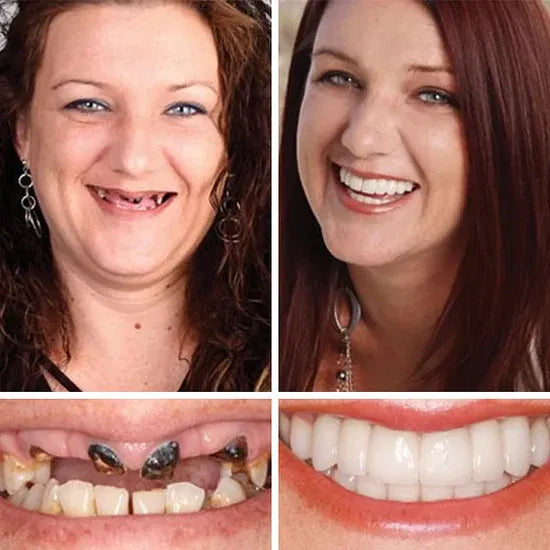 🔥Ends Today: 79% OFF!🏆2026 Bestselling Product🦷 Fit for a Fresh Smile, Say Goodbye to Wearing Discomfort!🌎
