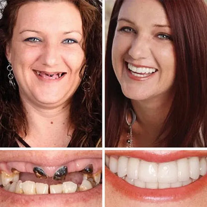 🔥Ends Today: 79% OFF!🏆2026 Bestselling Product🦷 Fit for a Fresh Smile, Say Goodbye to Wearing Discomfort!🌎