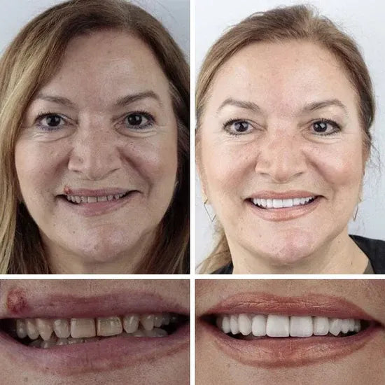 🔥Ends Today: 79% OFF!🏆2026 Bestselling Product🦷 Fit for a Fresh Smile, Say Goodbye to Wearing Discomfort!🌎